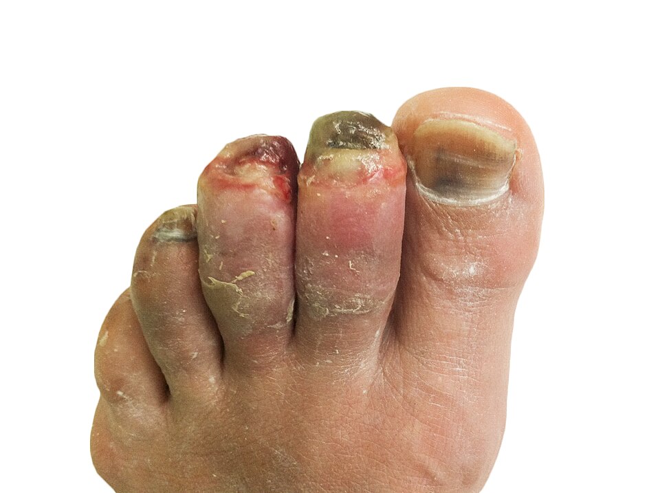 Súbor:Human toes, 3 weeks post-frostbite.jpg