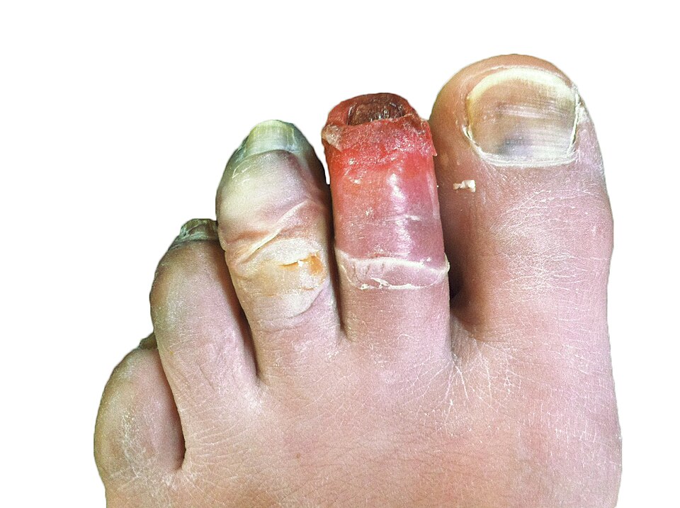 Súbor:Human toes, 12 days post-frostbite.jpg