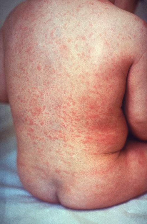 Súbor:Rash of rubella on skin of child's back.JPG